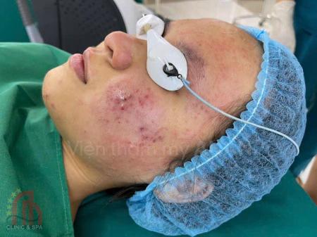 Địa chỉ chăm sóc da Mụn Hiệu Quả - Uy Tín tại Pleiku, Gia Lai